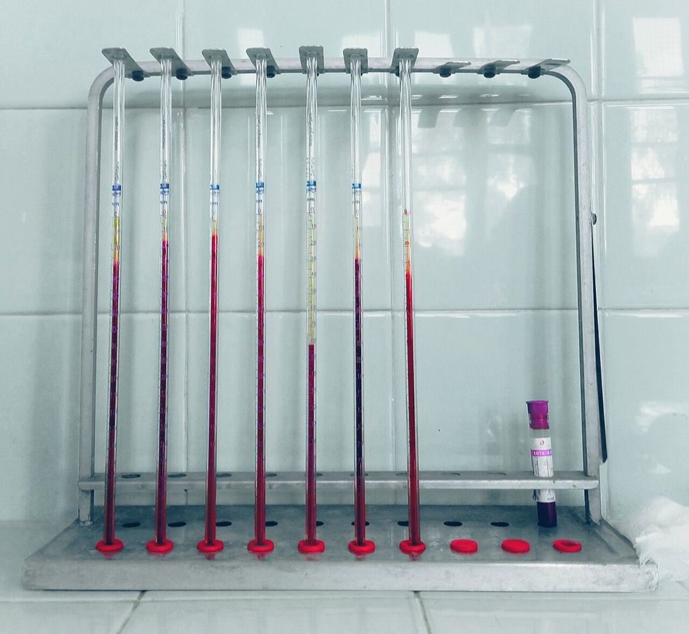 Seven Westergren pipettes in a rack, clear plasma above settled red cells; one tube shows a much longer plasma column
