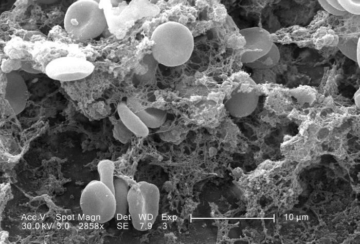 Scanning electron micrograph of red blood cells trapped in a dense mesh of fibrin strands