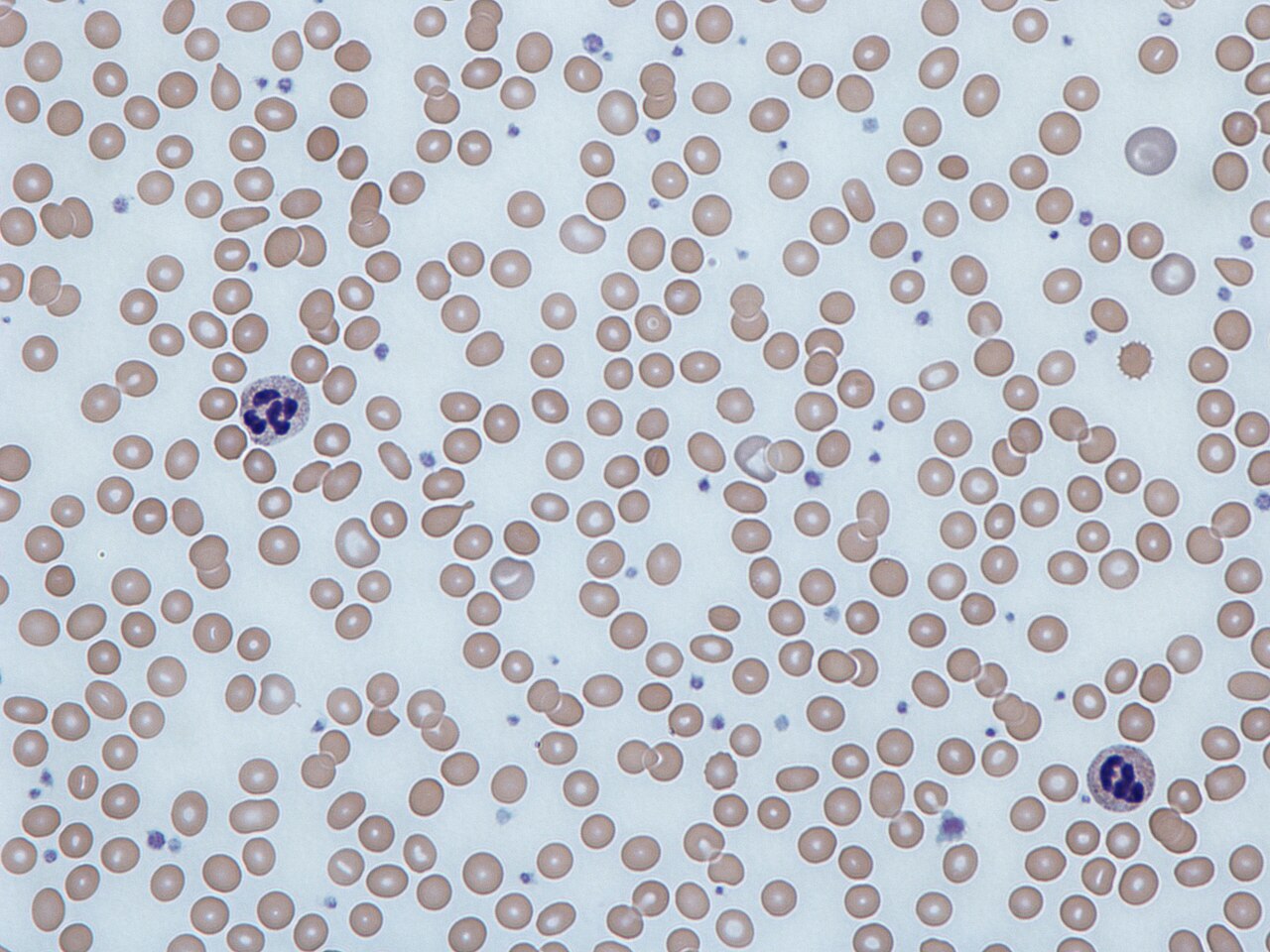 Blood smear in iron deficiency anemia: many small, pale red cells with widened central pallor
