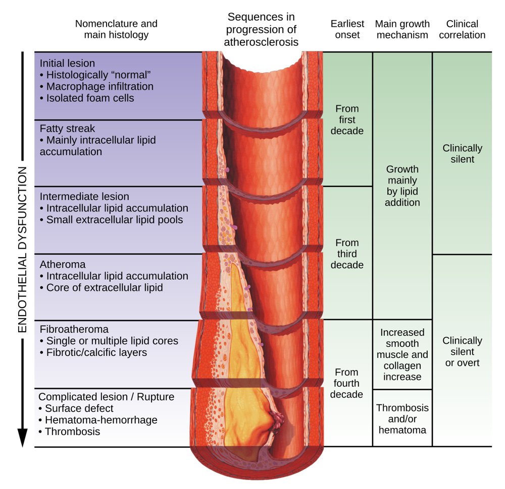 Diagram of artery from initial lesion and fatty streak to atheroma and ruptured plaque with thrombosis, by decade of life