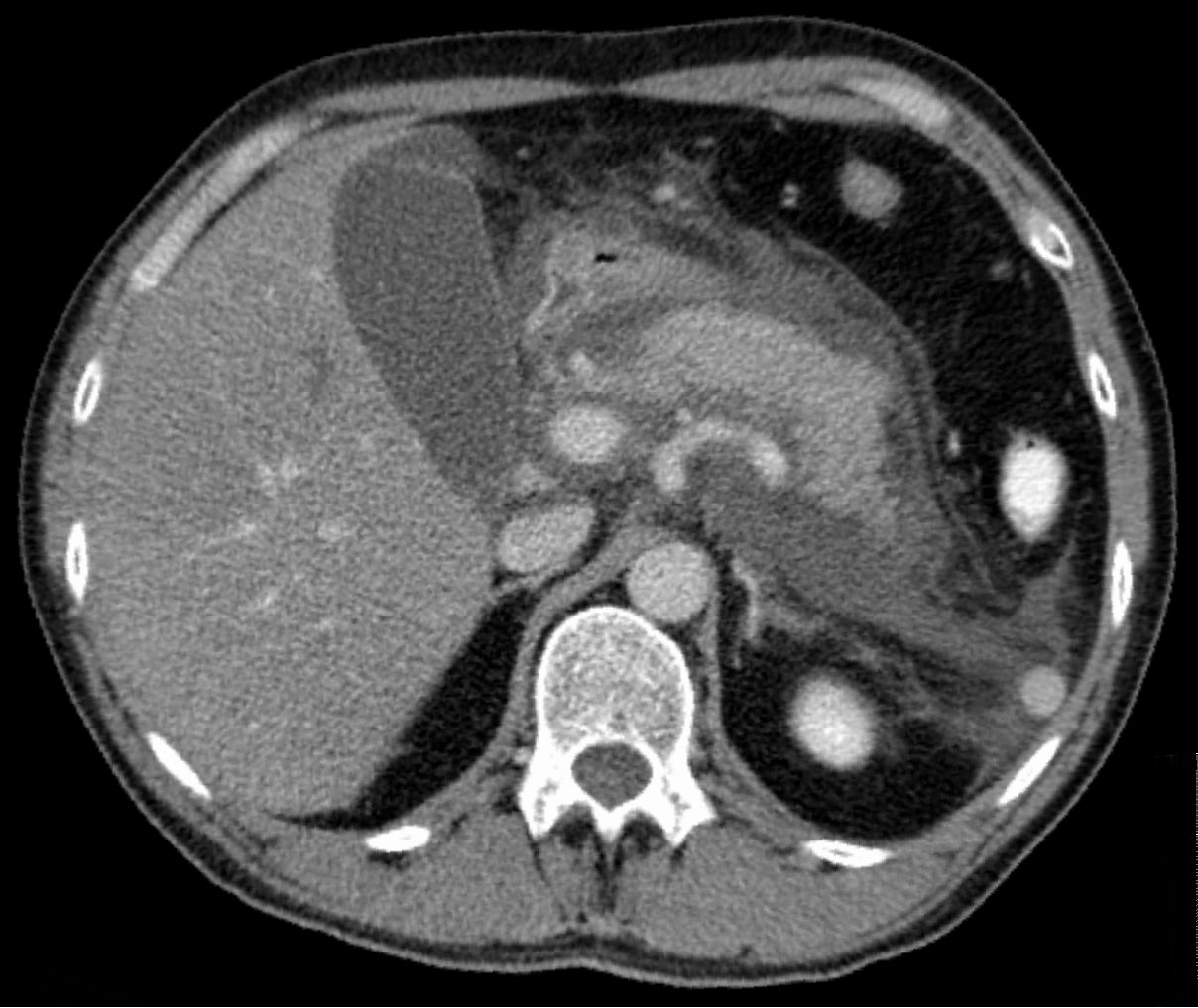 Axial CT of acute pancreatitis: enlarged pancreas with inflamed peripancreatic fat and fluid