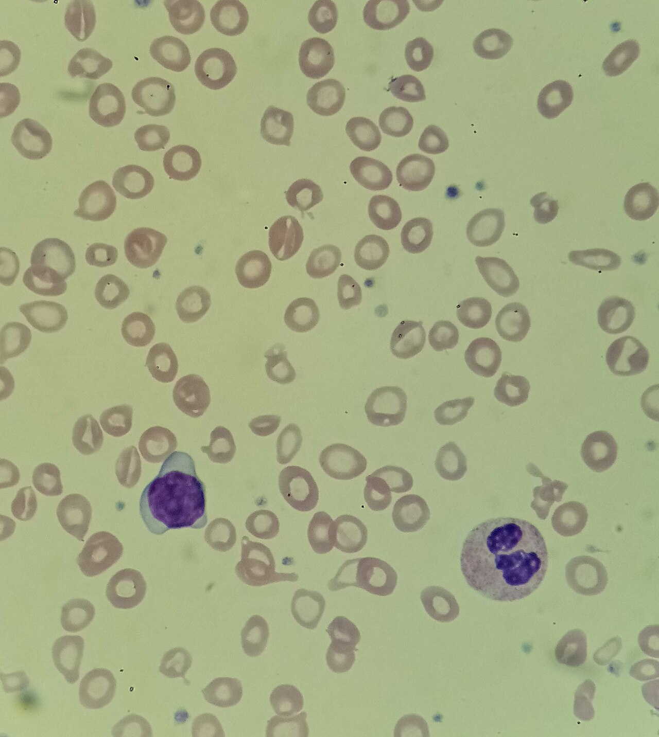 Iron deficiency smear: pale red cells with enlarged central pallor, ovalocytes and a few elongated forms