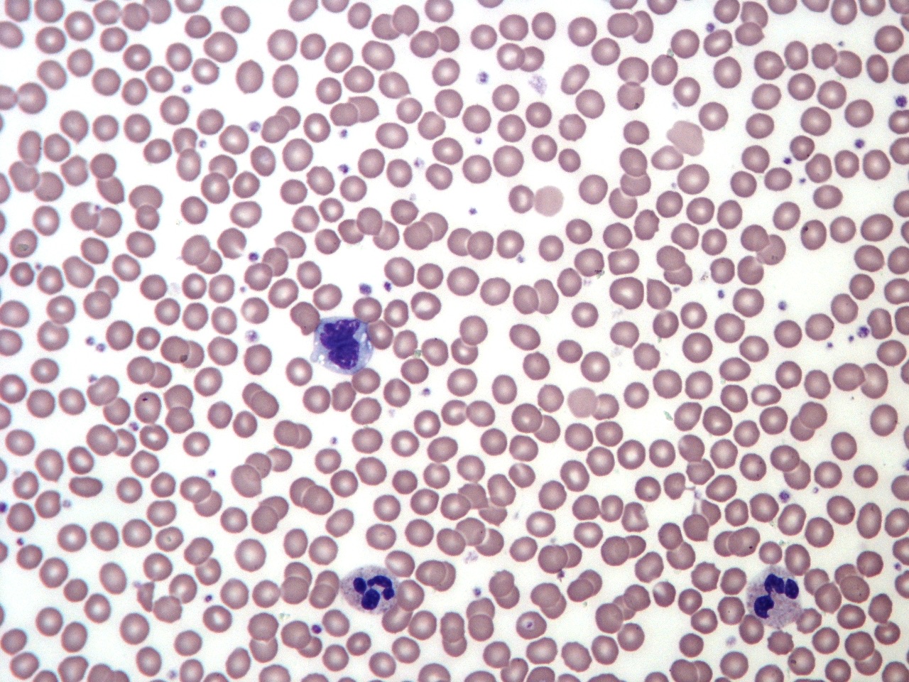 Normal adult blood smear: uniform red cells with a small central pale zone and full pink staining