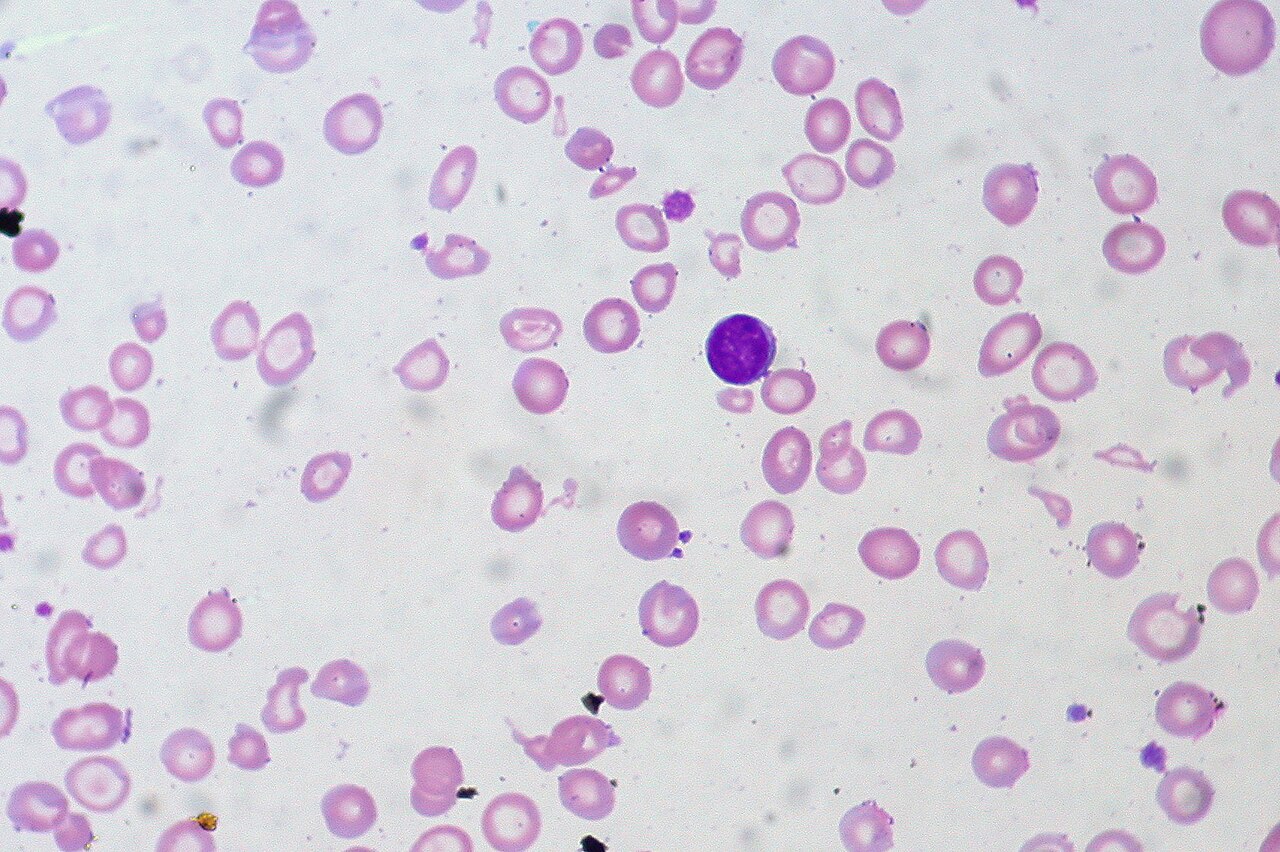 Blood smear of severe iron deficiency: small, pale red cells with wide central pallor beside a lymphocyte