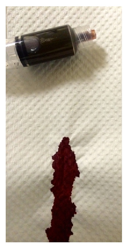 Dark chocolate-brown blood on paper towel beside a syringe