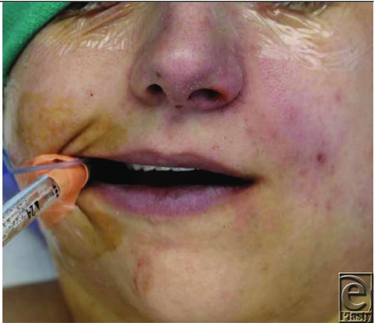 Face with grayish-brown discoloration around the mouth from benzocaine-induced methemoglobinemia