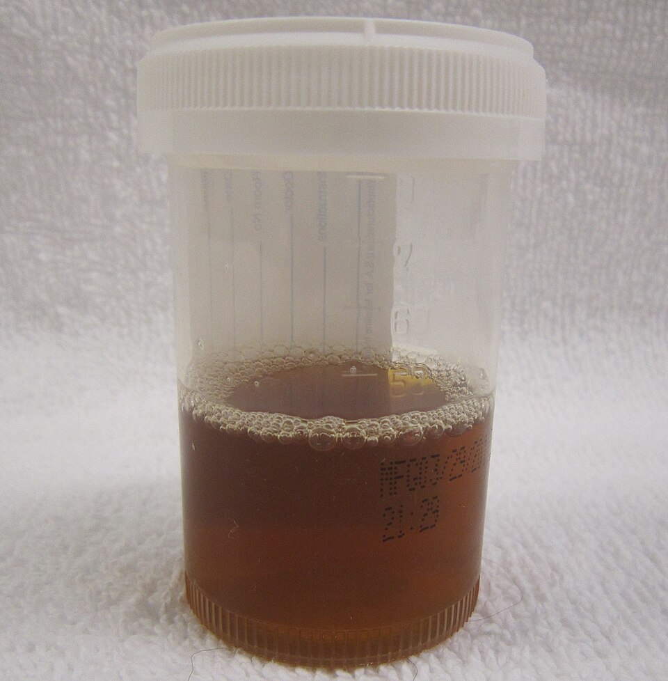 Specimen cup of dark brown, tea-colored urine from a patient with rhabdomyolysis (myoglobinuria)