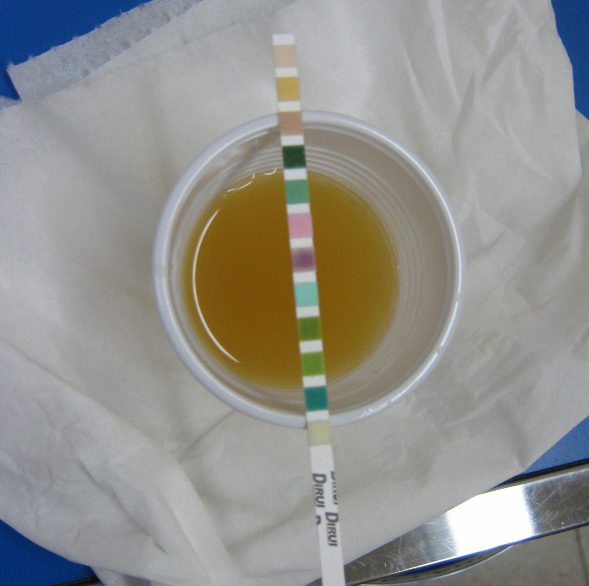 Amber, slightly turbid urine in a cup with a reagent strip; several pads changed colour, including pink and purple pads