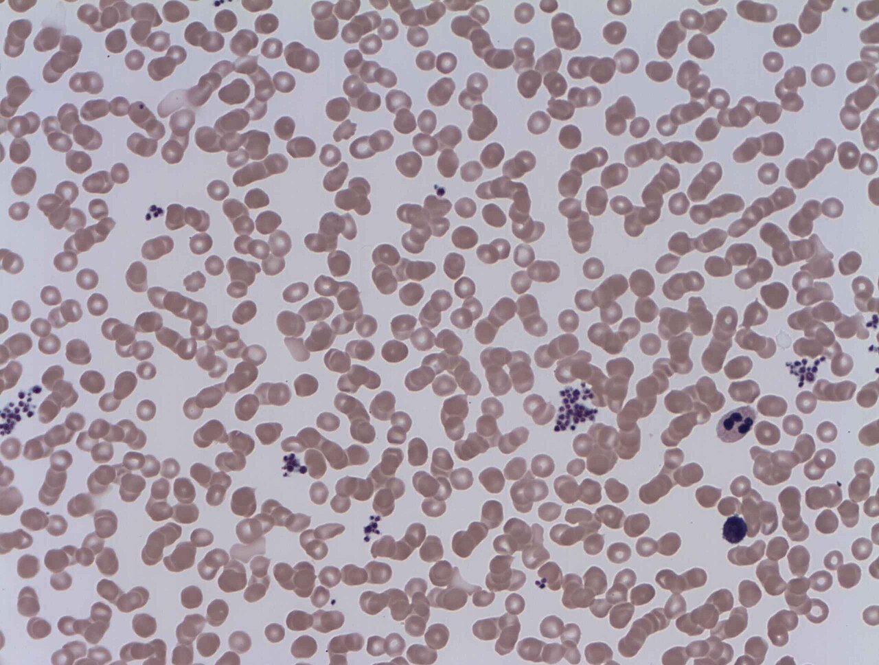 Blood smear with platelets gathered in purple clumps between red cells: EDTA clumping that falsely lowers the platelet count