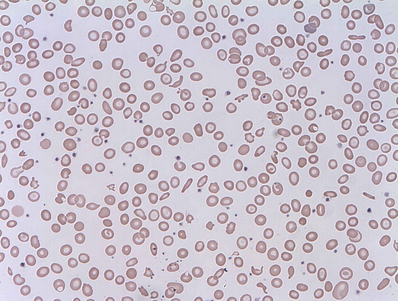 Blood smear with scattered fragmented red cells (schistocytes, including helmet and triangle forms) among mostly intact red cells, and few platelets