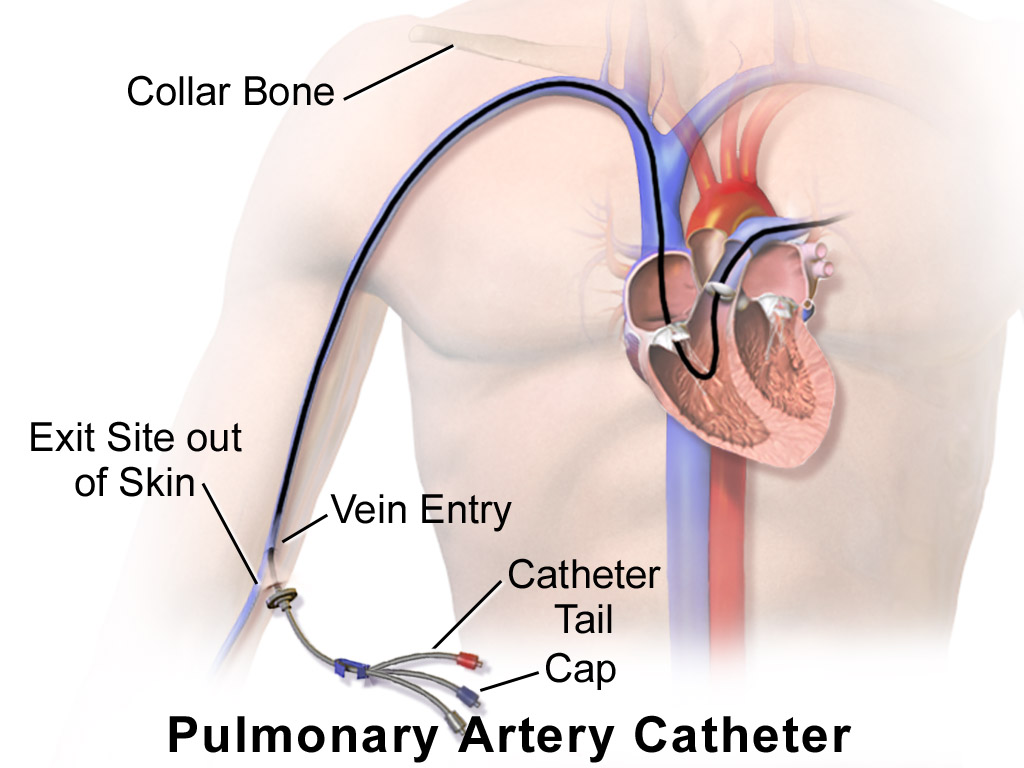 Pulmonary artery catheter from an arm vein through the right heart, tip in the pulmonary artery