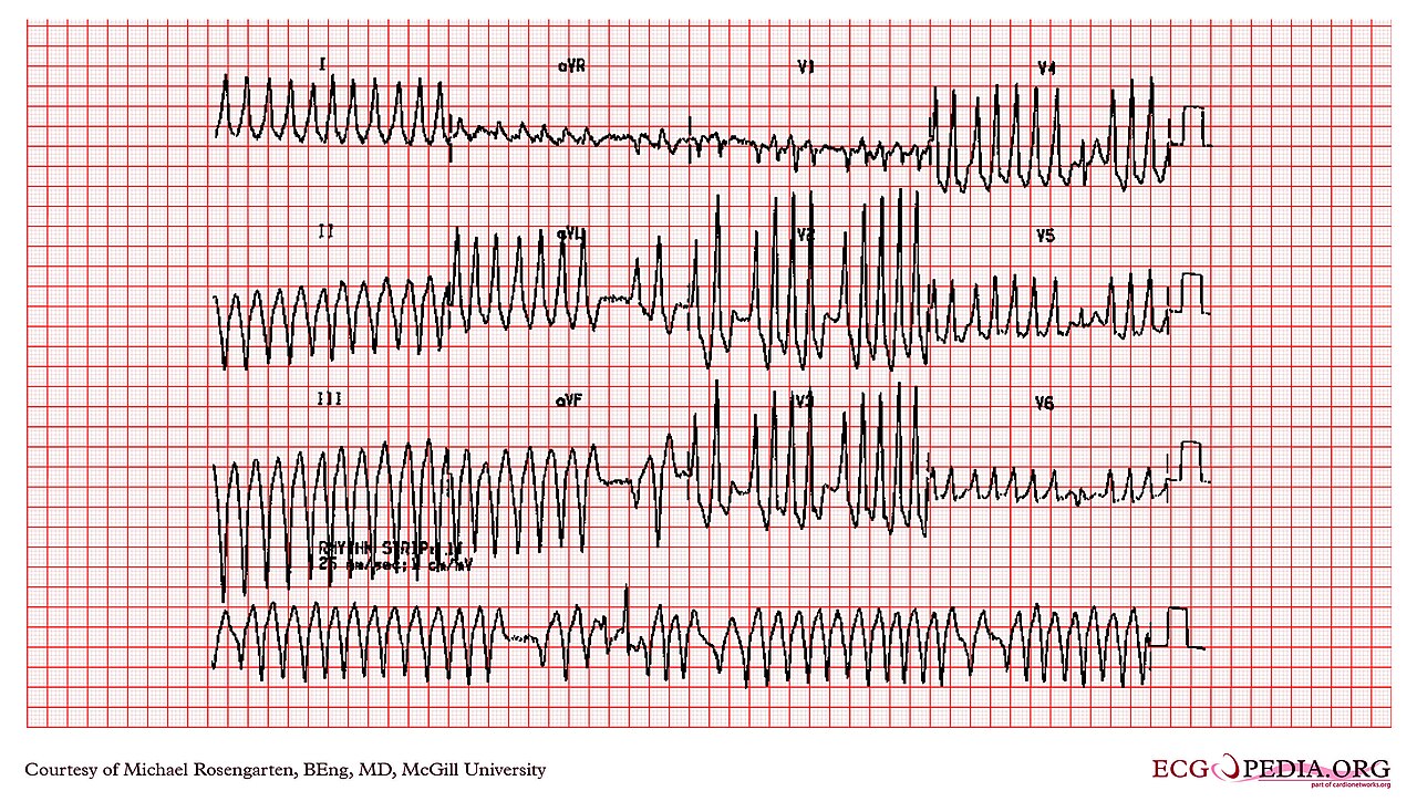 12-lead ECG of pre-excited AF in WPW: irregular broad-complex tachycardia with QRS width changing beat to beat