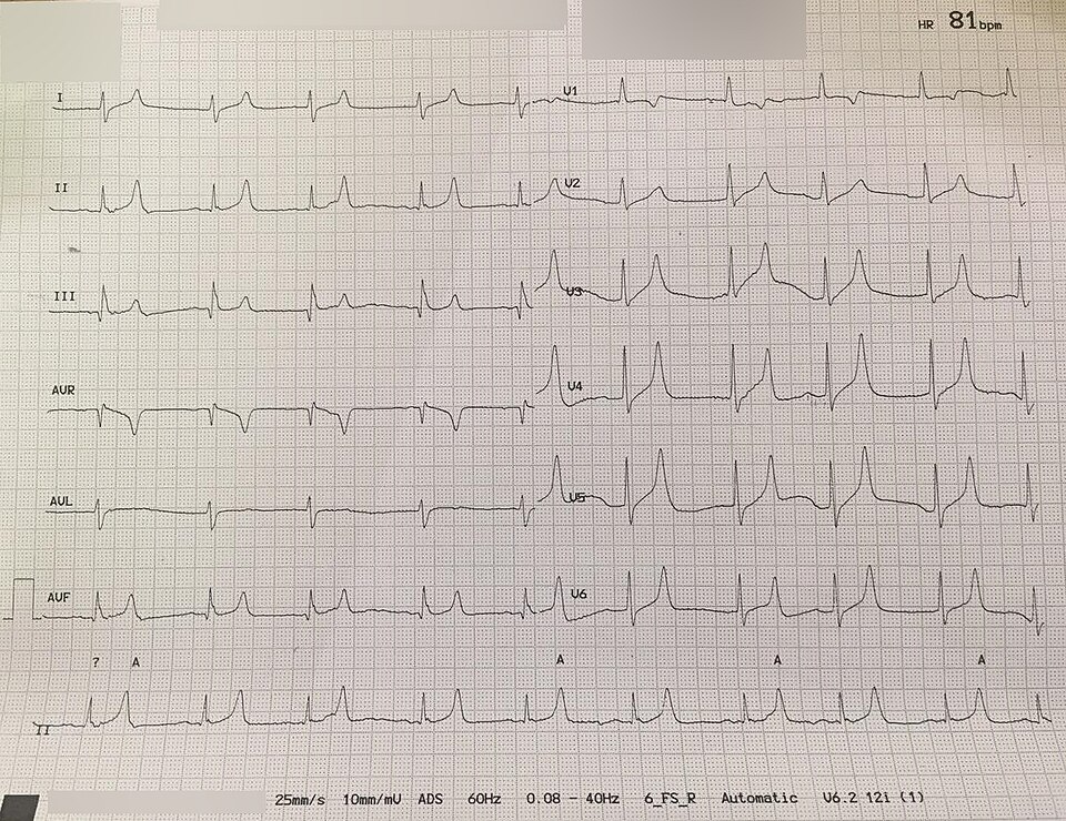 12-lead ECG with tall, narrow, peaked T waves across V2–V6 in a renal patient with K⁺ 8.2 mmol/L