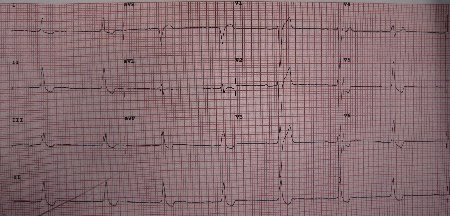 12-lead ECG labelled digoxin toxicity: regular rhythm with scooped ST depression in several leads