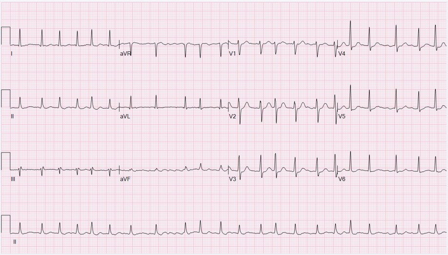 12-lead ECG of atrial fibrillation with rapid ventricular response: irregular narrow QRS tachycardia about 130 per minute