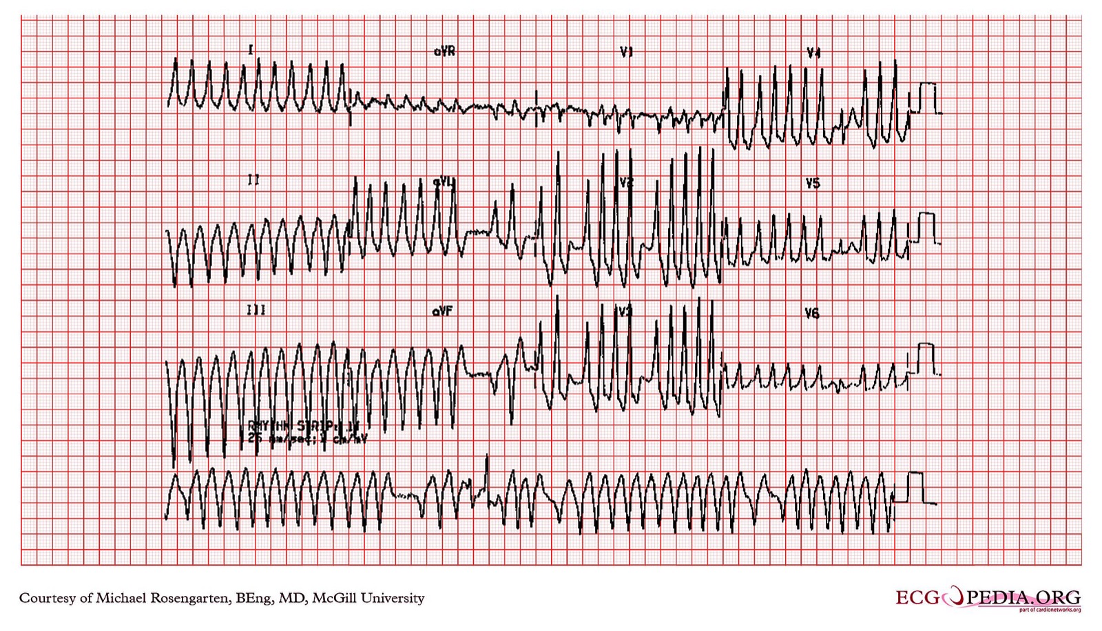12-lead ECG of atrial fibrillation with WPW: irregular broad-complex tachycardia over 200 per minute with varying QRS width