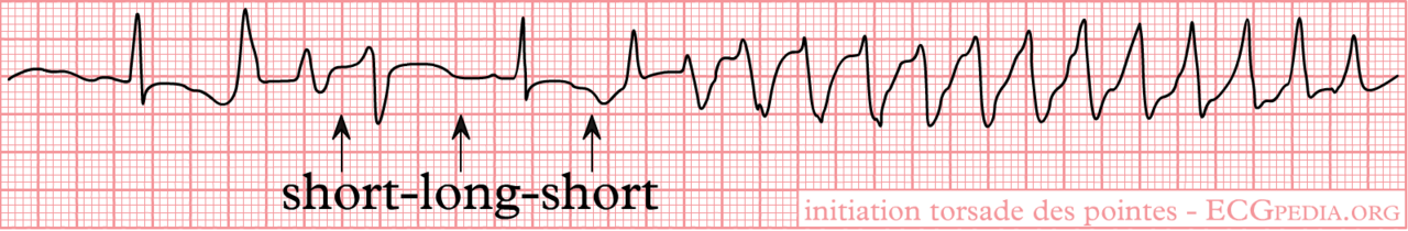 Rhythm strip: short-long-short beat sequence, then twisting polymorphic VT: onset of torsades de pointes