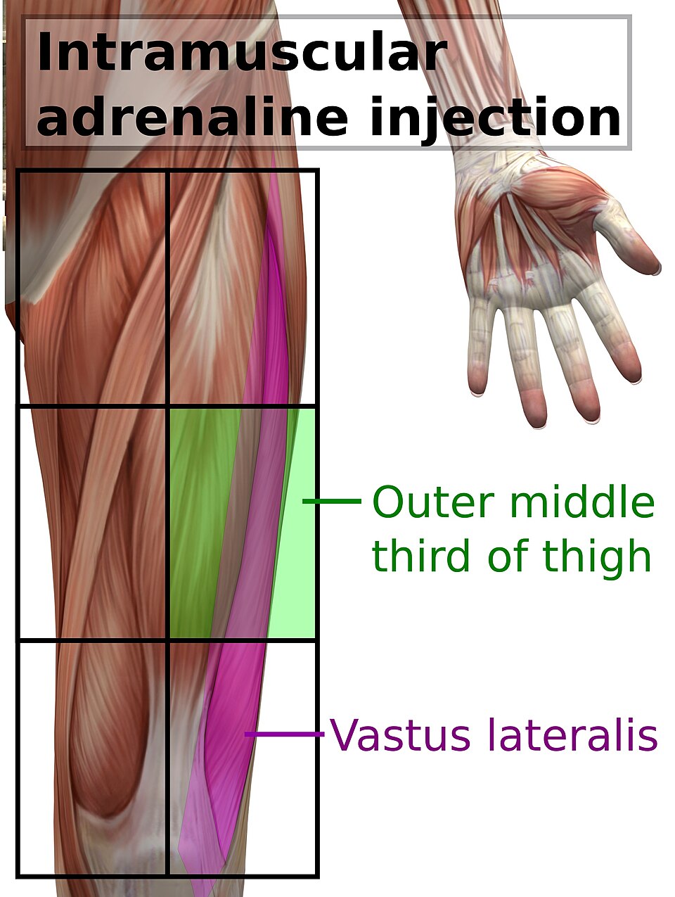 Thigh muscle diagram with the outer middle third shaded as the IM epinephrine site over the vastus lateralis