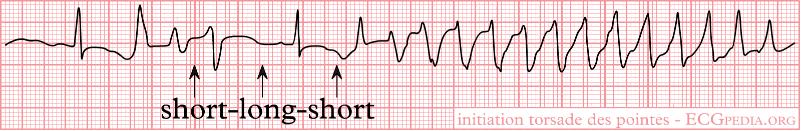 Rhythm strip: a short-long-short RR sequence, then a long-QT beat triggers twisting polymorphic VT (torsades)