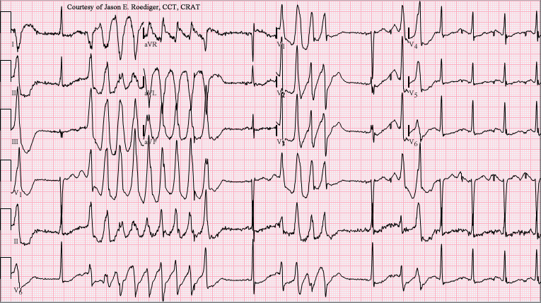 12-lead ECG with runs of twisting polymorphic VT between long-QT sinus beats: torsades de pointes