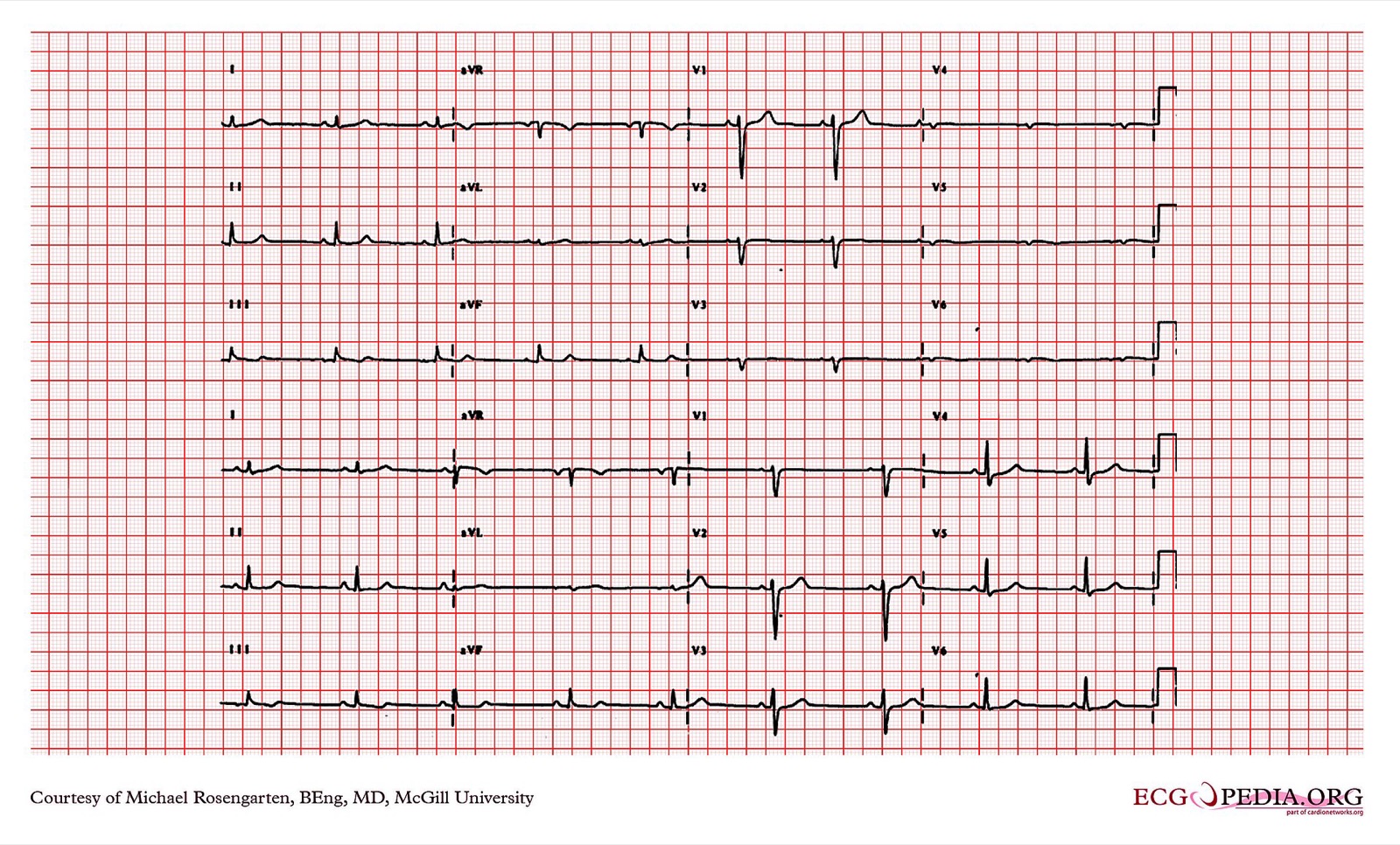 Two 12-lead ECGs from one patient: right-sided chest leads above, standard leads below, no ST elevation in V4R