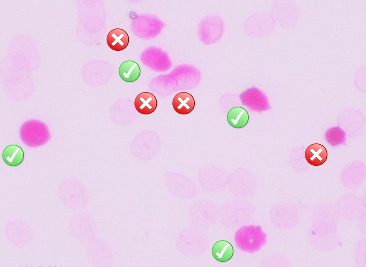 Kleihauer-Betke smear: dark pink fetal red cells marked with checks among pale adult red cell ghosts