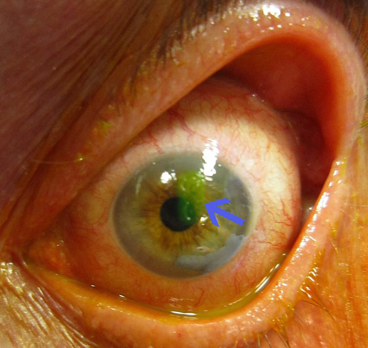 Red eye with a green fluorescein-stained corneal abrasion beside the pupil, marked by a blue arrow