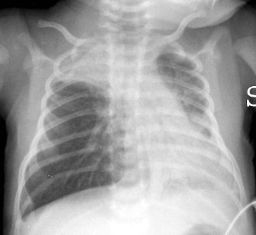 Chest radiograph of a 16-day-old infant with RSV showing hyperinflation, a flattened diaphragm and atelectasis