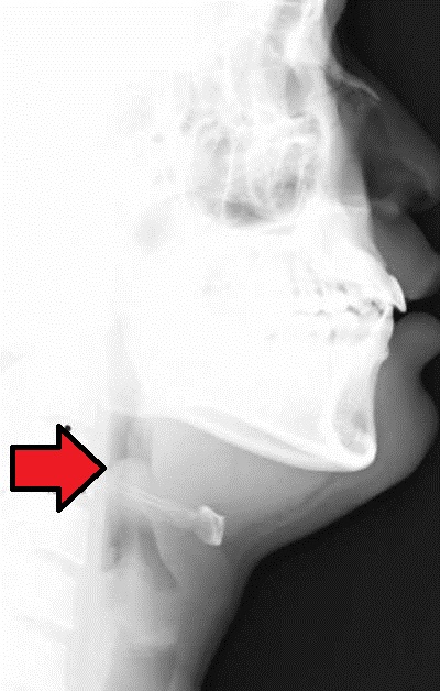 Lateral neck radiograph of acute epiglottitis showing a swollen epiglottis (thumb sign)