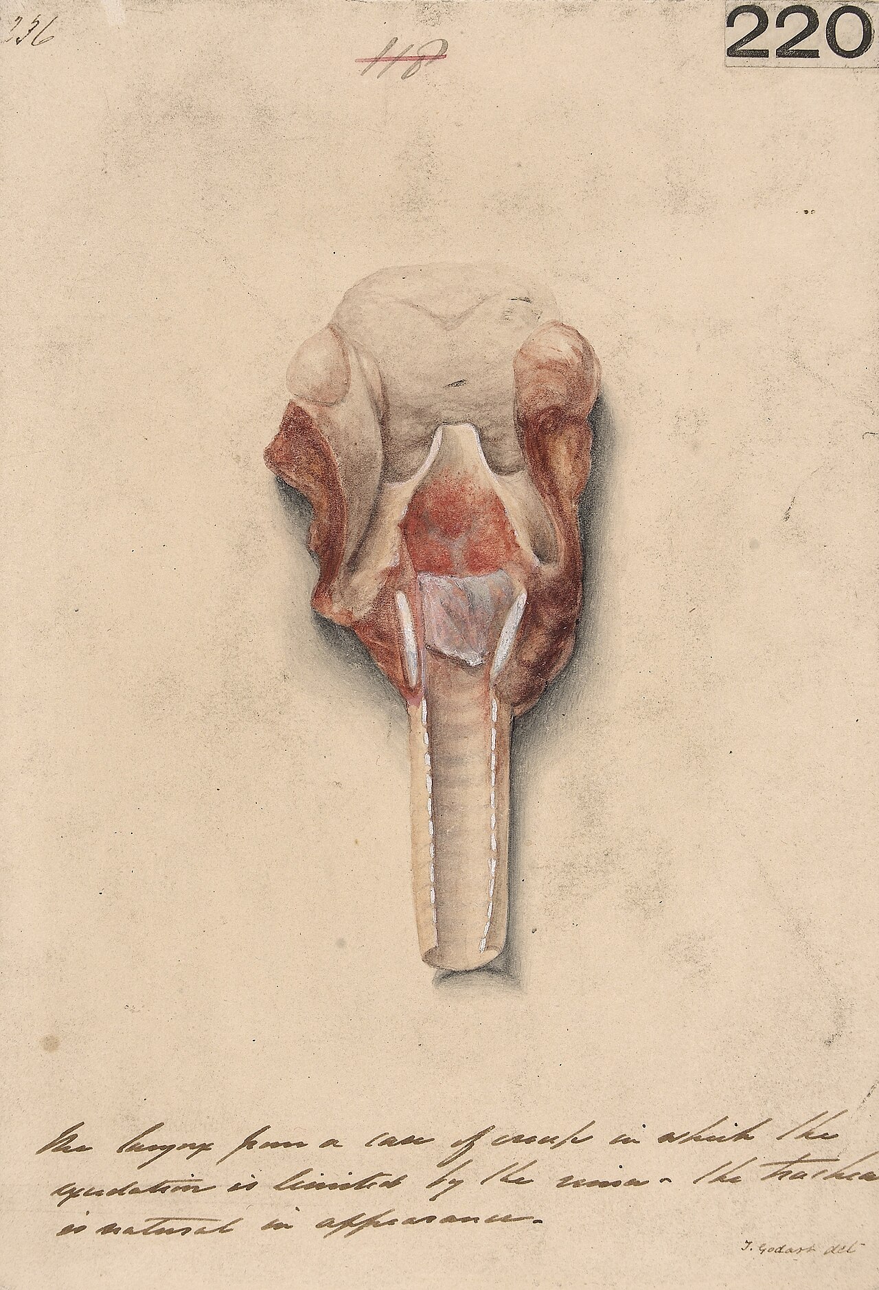Watercolour of a larynx from a case of croup, with exudate that does not extend below the glottis