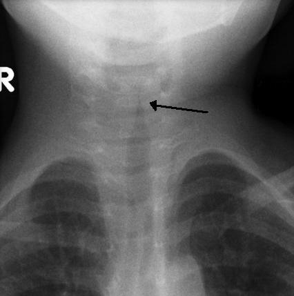 Anteroposterior neck radiograph of a child with croup showing subglottic narrowing (steeple sign)