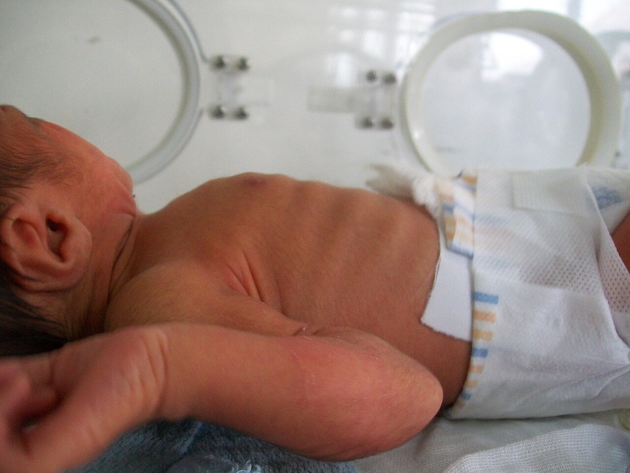 Newborn in an incubator with visible intercostal retractions, indrawing between the ribs