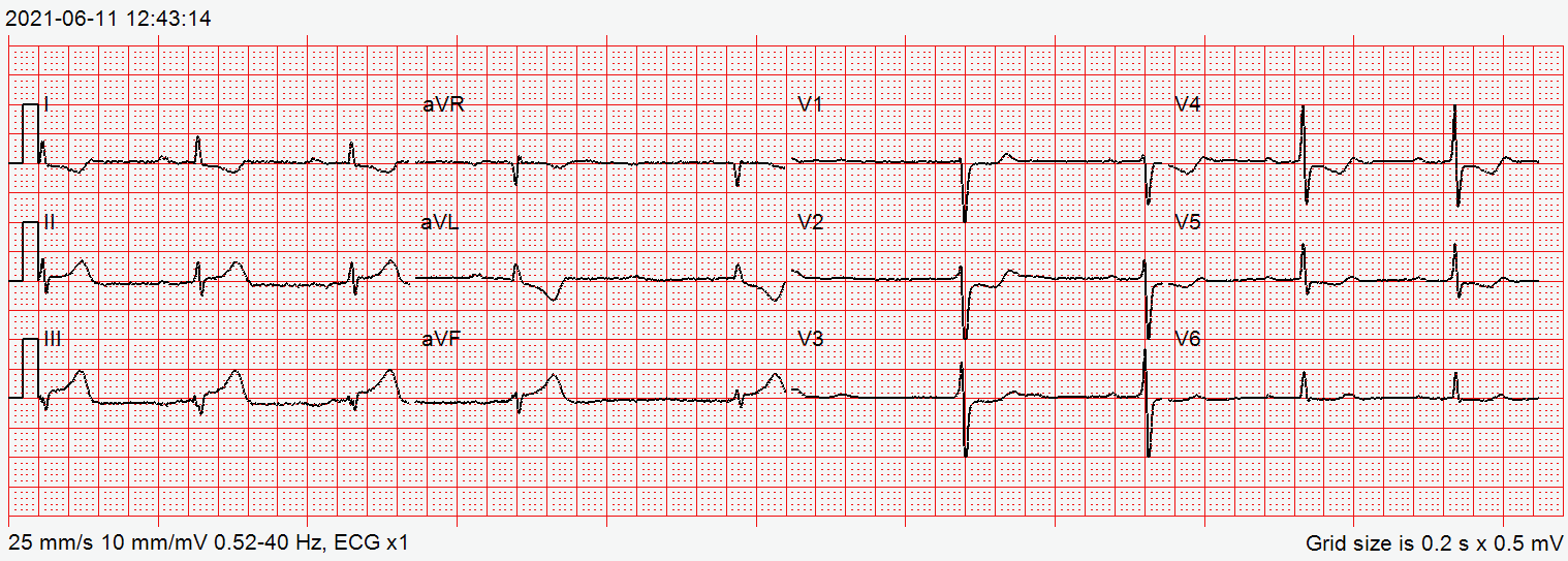 12-lead ECG with broad, tall T waves in II, III and aVF and T-wave inversion in aVL