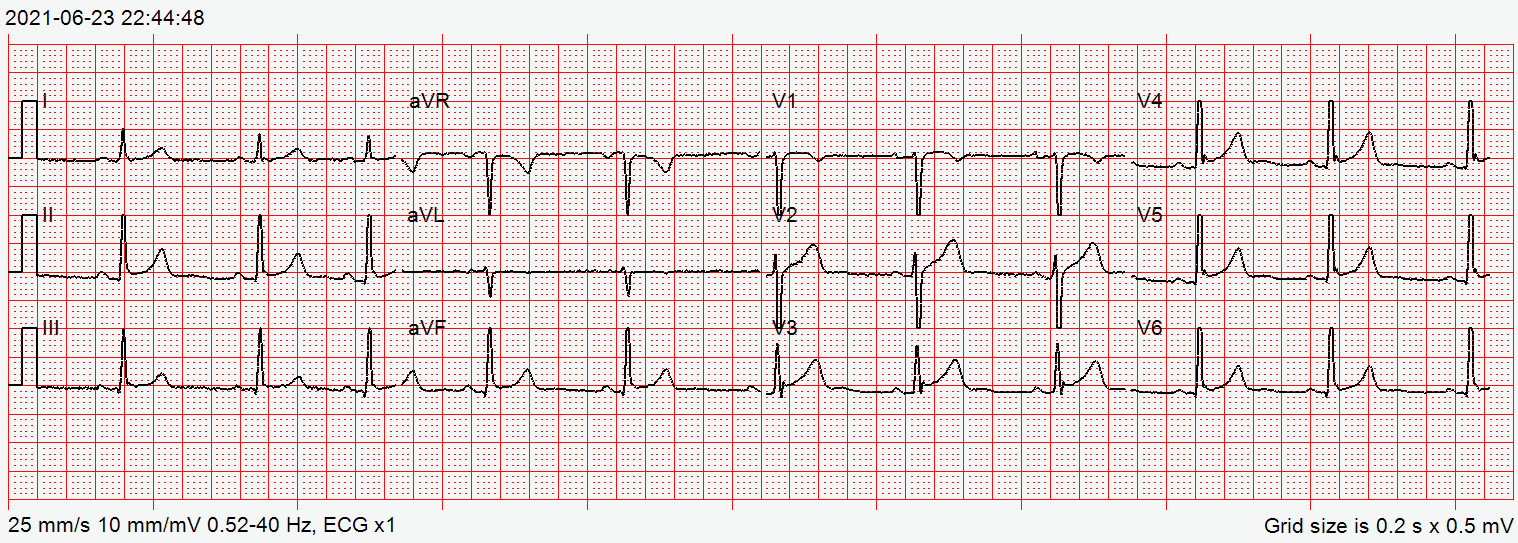12-lead ECG with ST elevation most prominent in V2 and V3 and tall T waves; diagnosis not confirmed