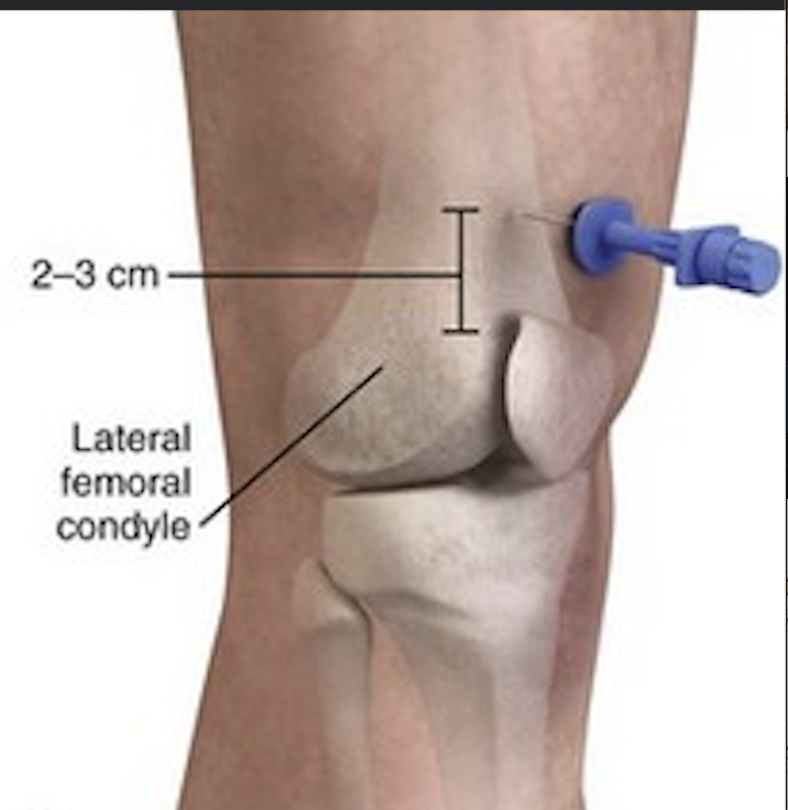 Distal femur anatomy for IO insertion