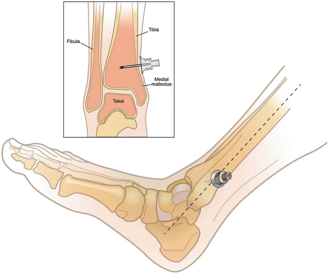 Distal tibia IO insertion above the medial malleolus, with an inset showing the needle in the tibia
