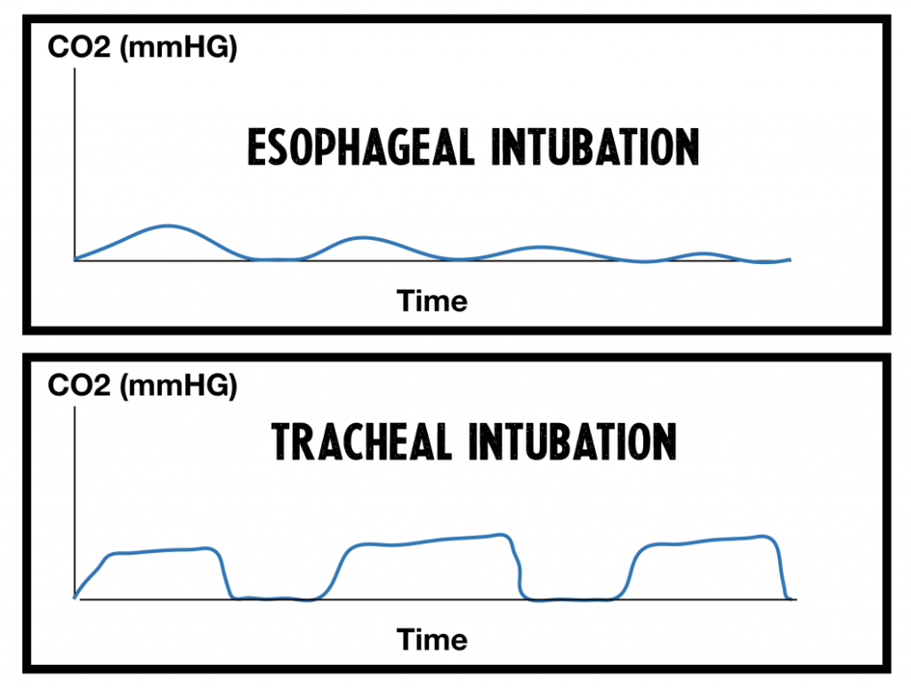 Esophageal vs tracheal intubation waveforms