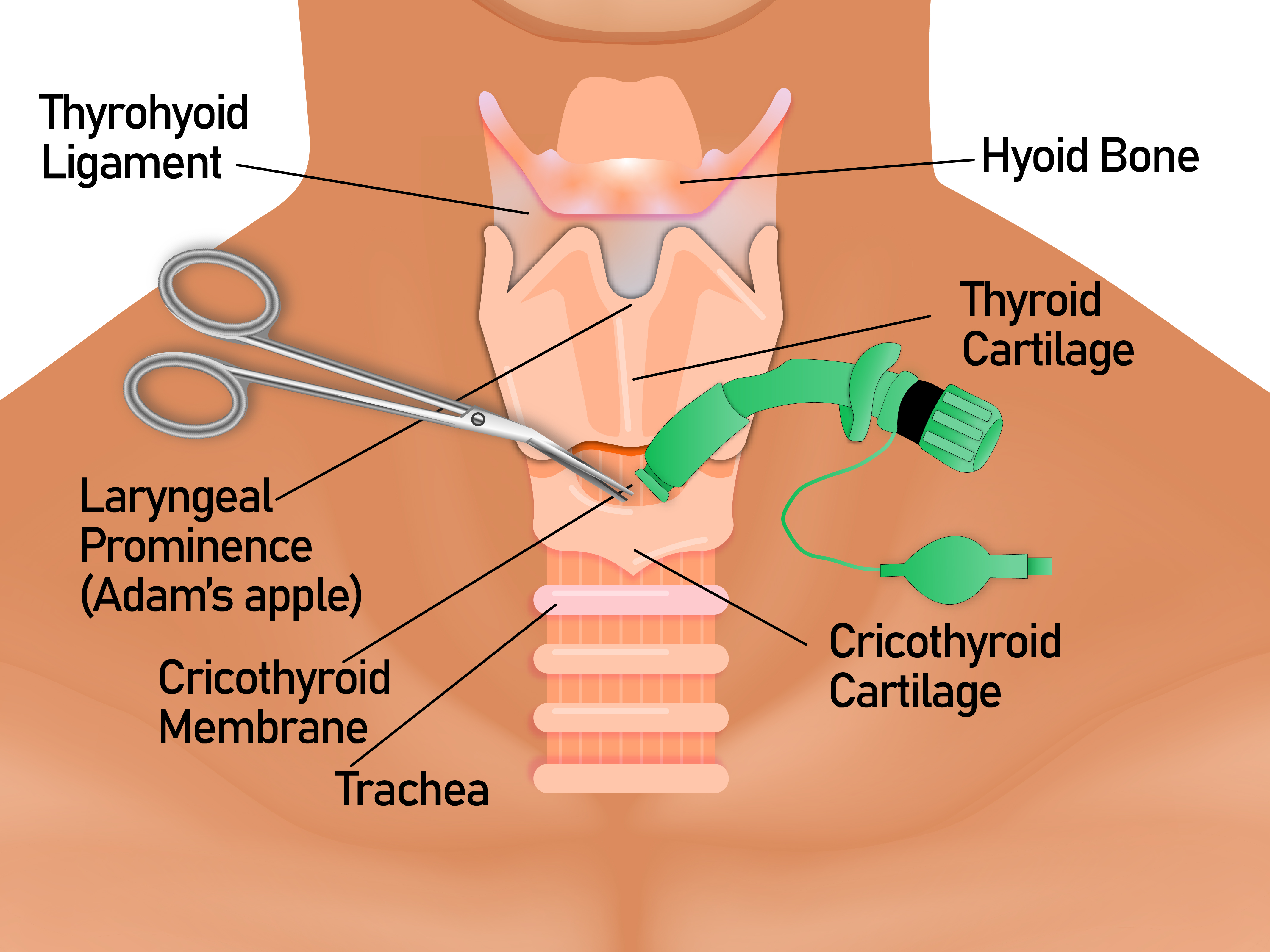 Cricothyroid membrane anatomy - the target area between thyroid and cricoid cartilages